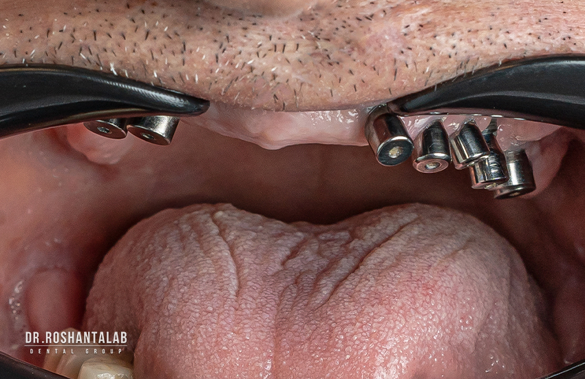 متخصص ایمپلنت در رشت دکتر روشن طلب