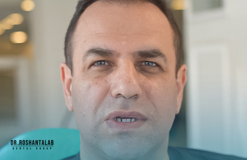 کاشت ایمپلنت توسط دکتر روشن طلب