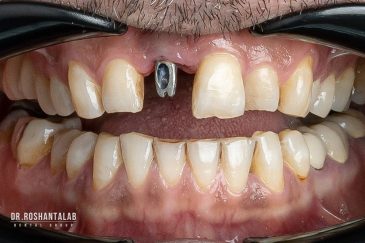 ایمپلنت یک روزه در رشت