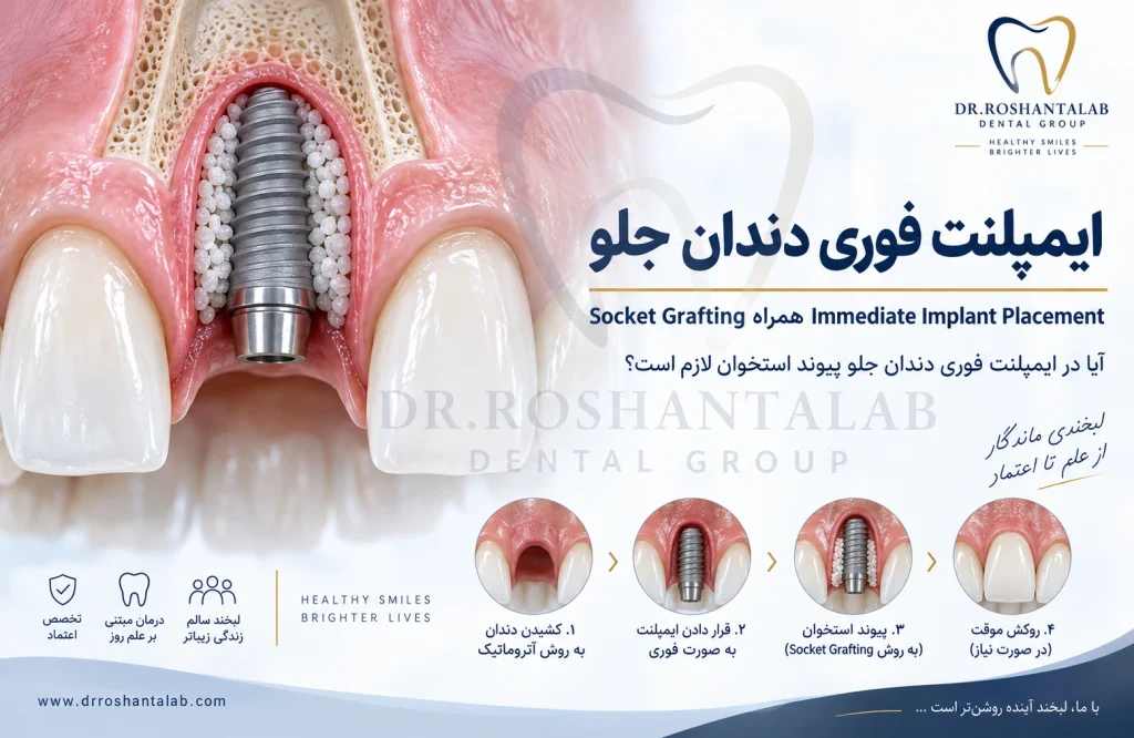 آیا در ایمپلنت فوری دندان جلو پیوند استخوان لازم است؟