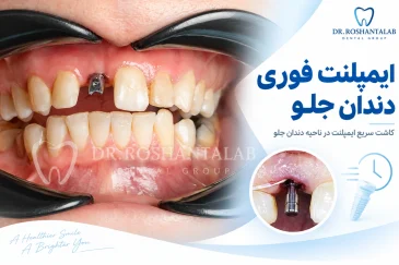 ایمپلنت فوری دندان جلو؛ 7 نکته مهم برای حفظ زیبایی لبخند