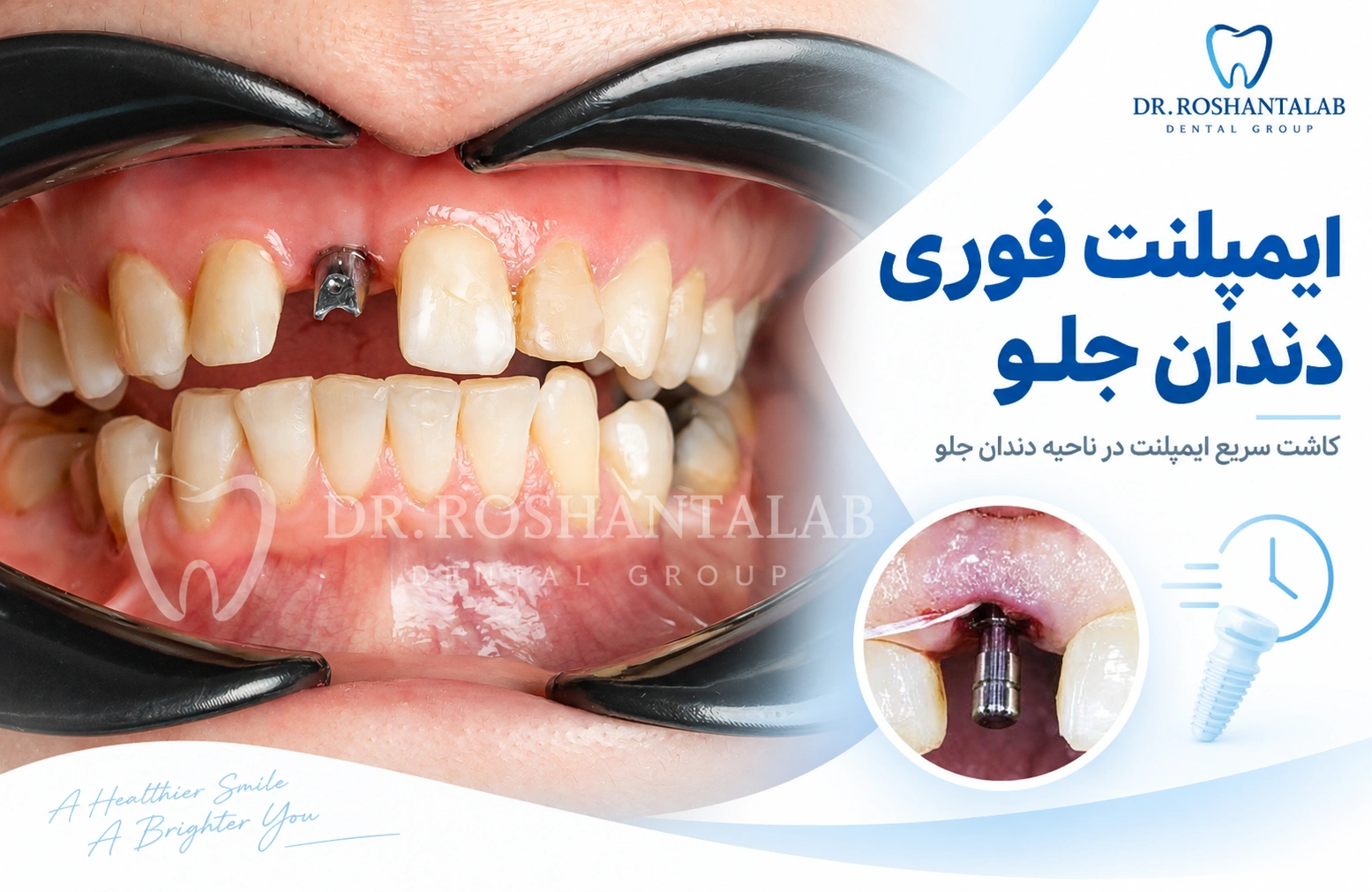 ایمپلنت فوری دندان جلو؛ 7 نکته مهم برای حفظ زیبایی لبخند