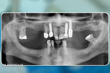 کاشت ایمپلنت توسط دکتر روشن طلب