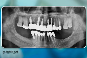 کاشت ایمپلنت توسط دکتر روشن طلب