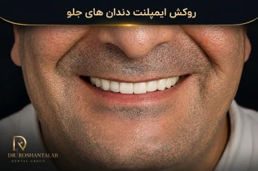 روکش ایمپلنت دندان رشت