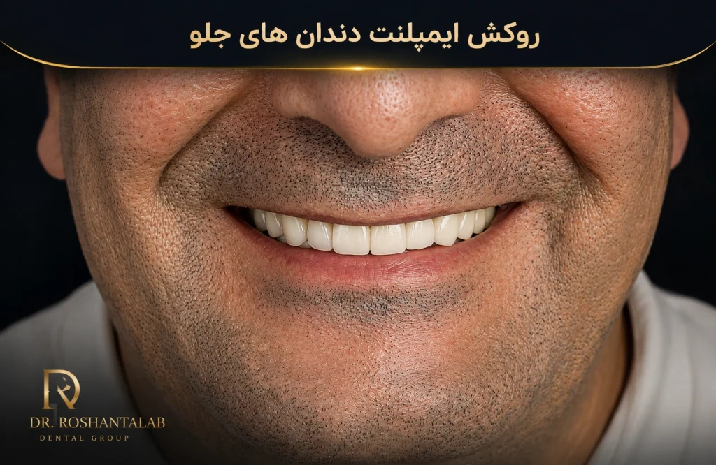 روکش ایمپلنت دندان جلو ( عکس بعد)
