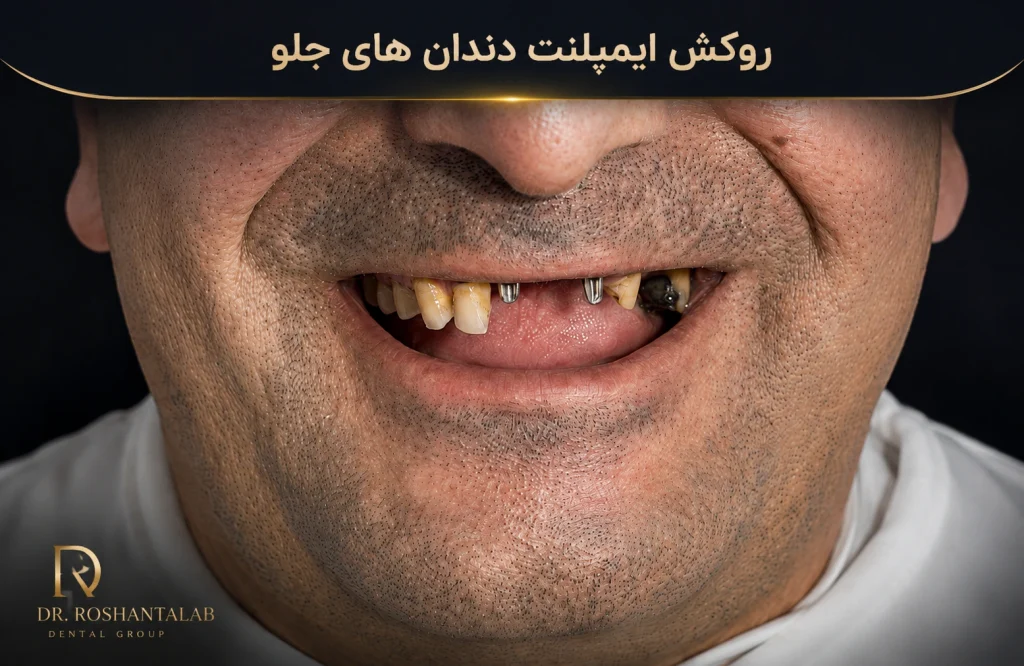  روکش ایمپلنت دندان جلو ( عکس قبل)