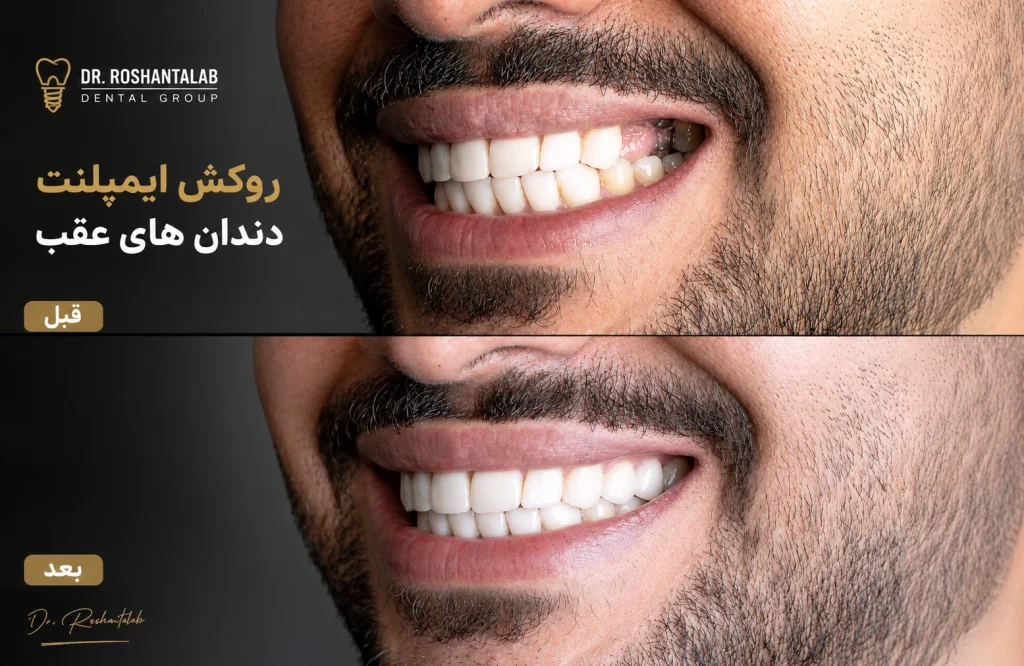 روکش چندواحدی دندان‌های عقب