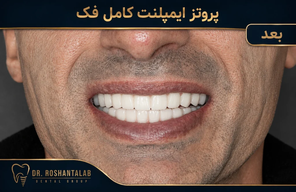 پروتز ایمپلنت کامل فک عکس بعد