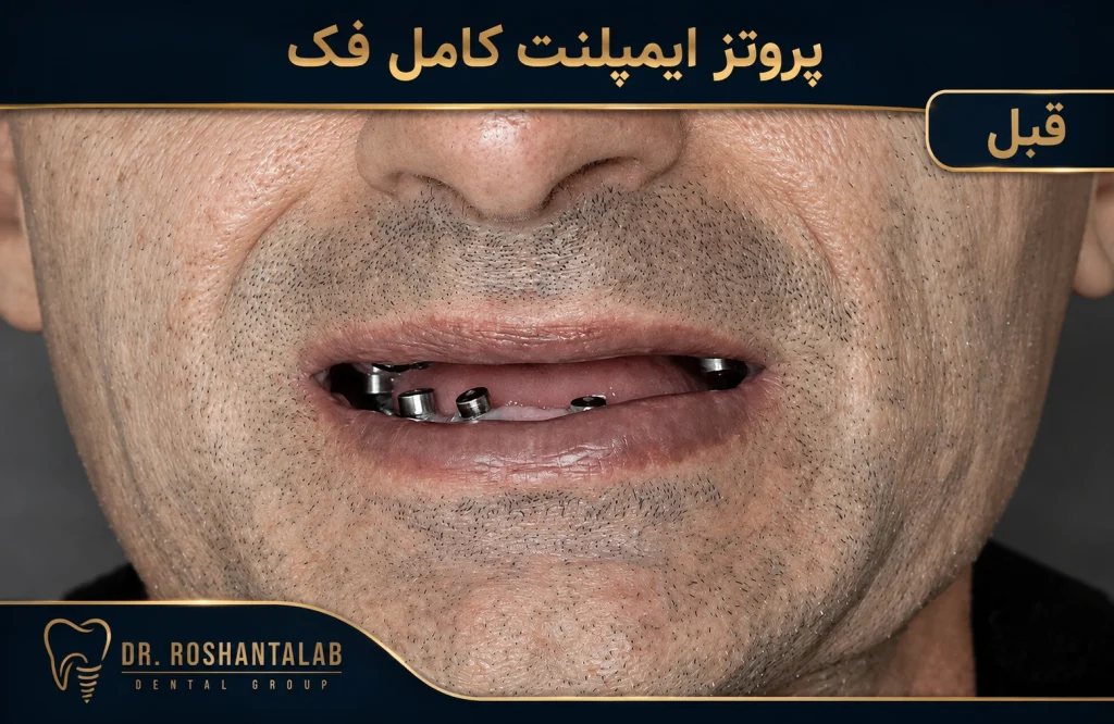 پروتز ایمپلنت کامل فک عکس قبل