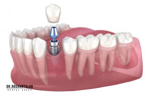 کاشت ایمپلنت توسط دکتر روشن طلب