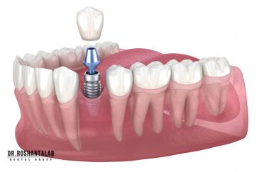 کاشت ایمپلنت توسط دکتر روشن طلب