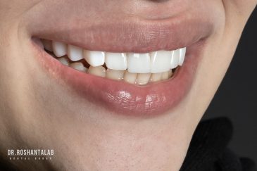 باورهای اشتباه در مورد کامپوزیت ونیر