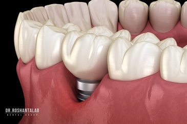 کاشت ایمپلنت توسط دکتر روشن طلب