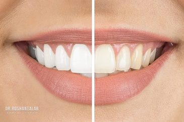 مراقبت های بعد از بلیچینگ دندان