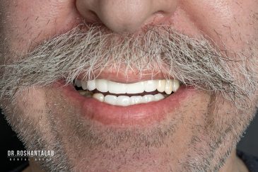 کاشت ایمپلنت توسط دکتر روشن طلب