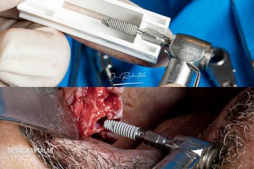 کاشت ایمپلنت توسط دکتر روشن طلب