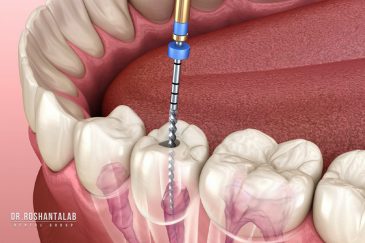 عصب کشی دندان در رشت