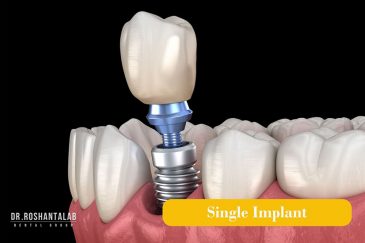 قیمت ایمپلنت کره ای