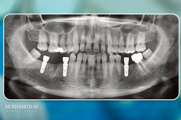 کاشت ایمپلنت توسط دکتر روشن طلب