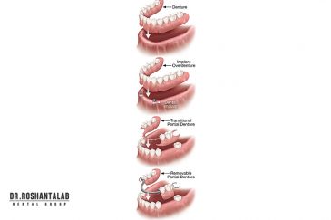 کاشت ایمپلنت توسط دکتر روشن طلب