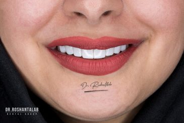 کامپوزیت ونیر دندان