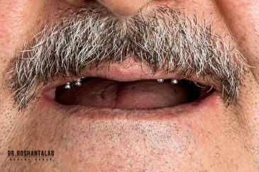 کاشت ایمپلنت توسط دکتر روشن طلب