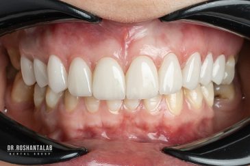 لمینت سرامیکی