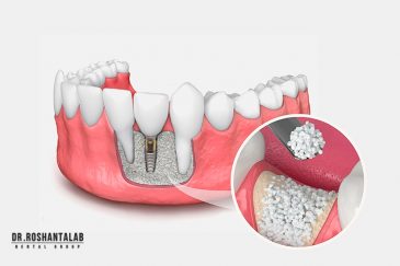 پودر استخوان و کاربرد آن در ایمپلنت