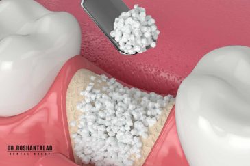 پودر استخوان و کاربرد آن در ایمپلنت