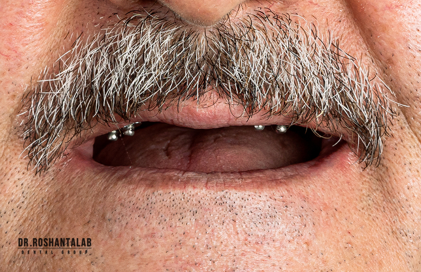 کاشت ایمپلنت توسط دکتر روشن طلب