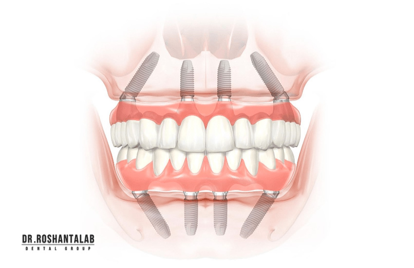 all on 4: ایمپلنت در فک بالا و پایین
