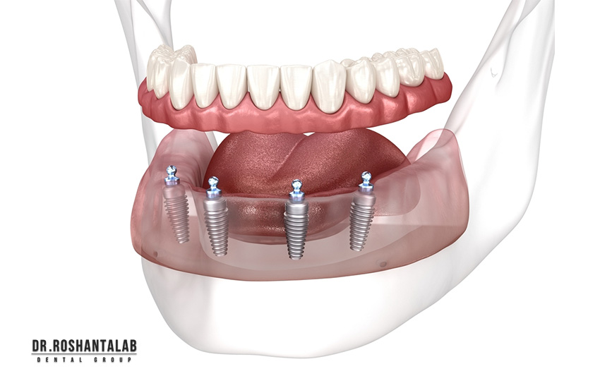 اوردنچر : ایمپلنت کامل فک بالا و پایین