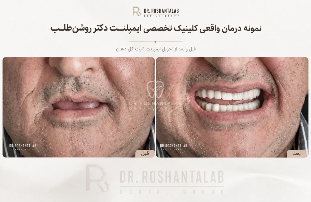 عکس واقعی ایمپلنت ثابت کل دهان کلینیک تخصصی ایمپلنت دکتر روشن طلب