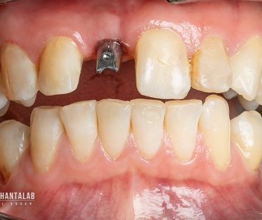 کاشت ایمپلنت توسط دکتر روشن طلب