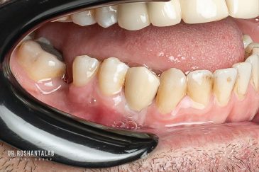 کاشت ایمپلنت توسط دکتر روشن طلب