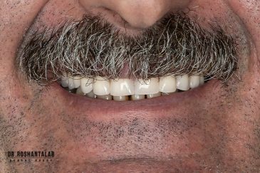 کاشت ایمپلنت توسط دکتر روشن طلب