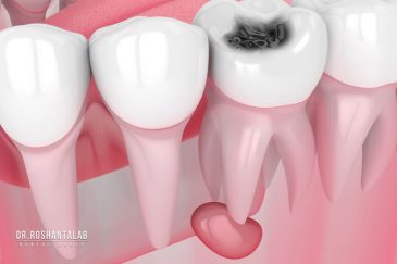 کشیدن دندان عفونی امکان پذیر است؟