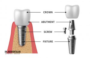 کاشت ایمپلنت توسط دکتر روشن طلب
