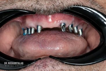 کاشت ایمپلنت کامل دندان