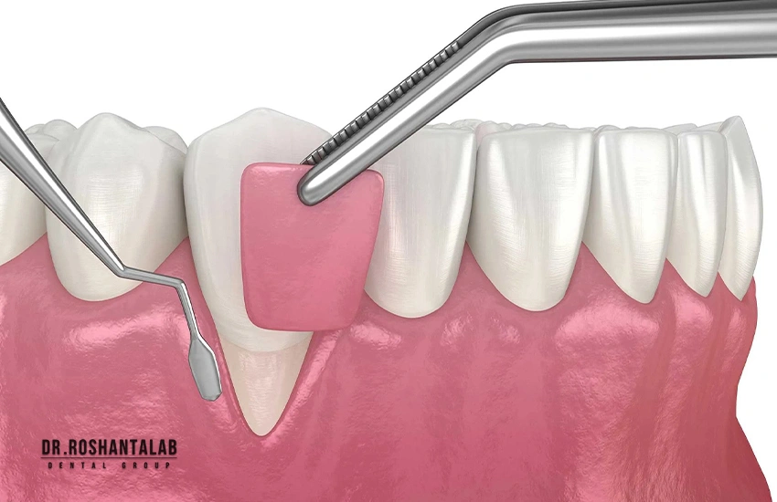 تحلیل لثه بعد از ایمپلنت: جراحی پیوند بافت نرم (Soft Tissue Grafting)