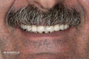 کاشت ایمپلنت توسط دکتر روشن طلب