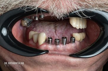 ایمپلنت دندان چیست؟ مزایا، مراحل و هزینه، 5 توصیه مهم