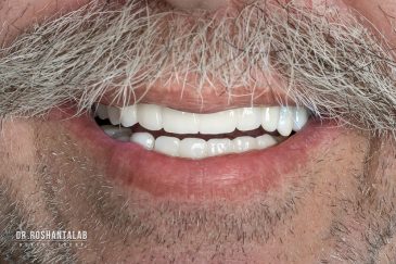 کاشت ایمپلنت توسط دکتر روشن طلب