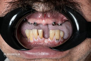 کاشت ایمپلنت توسط دکتر روشن طلب