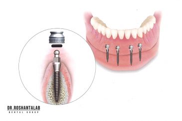 مینی ایمپلنت دندان چیست؟ 5 مزیت که دندان مصنوعی را نابود کرد!