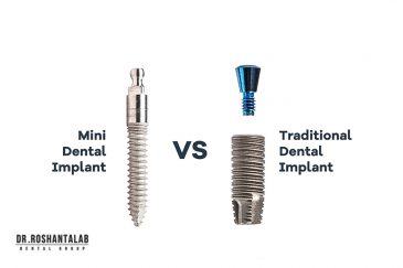 تفاوت مینی ایمپلنت با ایمپلنت معمولی چیست؟