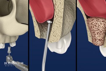 چه زمانی به جراحی سینوس لیفت نیاز داریم؟