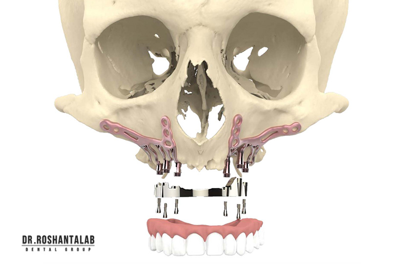 ساب‌پریوستئال