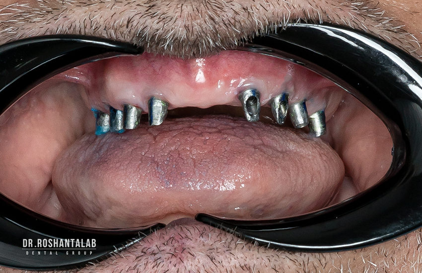 مزایای ایمپلنت دندان با بیهوشی